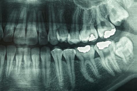 How Safe Are Dental X Rays Whats Involved And Why Theyre Performed