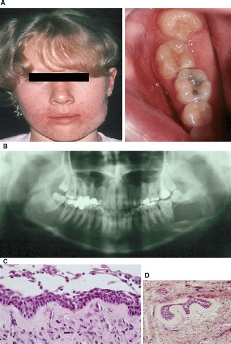 A B C D 18 Year Old Girl With Unicystic Ameloblastoma Presenting