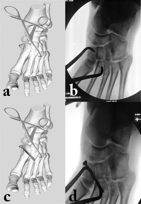 Percutaneous Fixation Of Lisfranc Injuries Journal Of Clinical