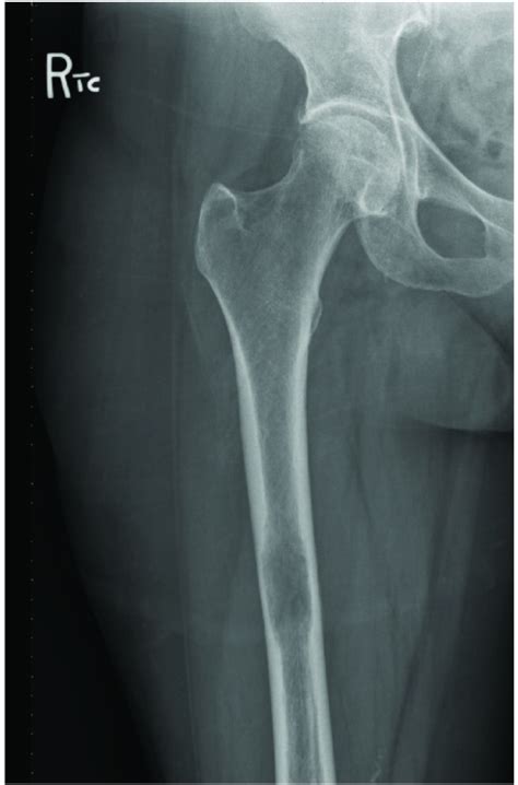 X Ray Right Femur Ap View Demonstrates A Large Lucent Lesion Of The