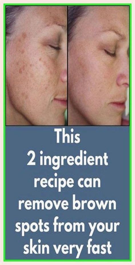 This Is A Splendid Info Brown Spots On Skin Skin Spots Dark Spots On