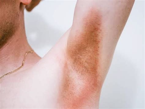 Armpit Rashes Causes Symptoms And How To Treat Them 46 Off
