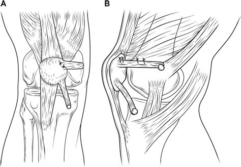 Insertion And Reconstruction Of Medial Patellofemoral Ligament With