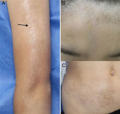 pediatric generalized morphea that developed at a bcg vaccination site actas dermo sifiliográficas