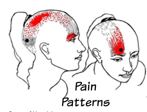 Pin By Angel Carter On Occipital Neuralgia Trigger Points
