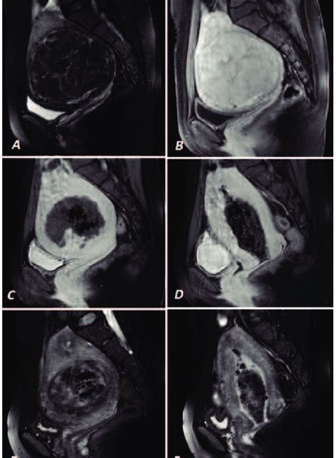 A Preoperative T2w And B T1w Contrast Sagittal Images Of A