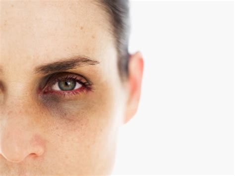 The Truth About Dark Circles Causes And Links To Diseases