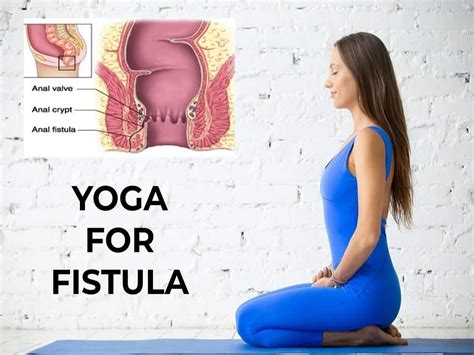 Yoga For Fistula Asanas To Practice While Recovering From The Surgery