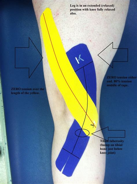 Kinesio Taping Kt A Rehabilitative Taping Technique That Is Designed