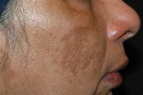 Skin Pigmentation Results Environ Skin Care
