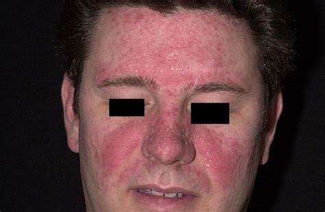 Seborrheic Dermatitis Face Dorothee Padraig South West Skin Health Care