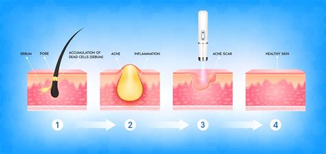 Formation Of Skin Acne Or Pimple Accumulation Of Dead Cells The Sebum