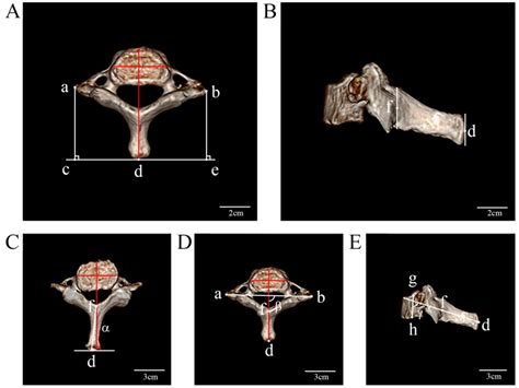 An Anatomical Study Of The Spinous Process Of The Seventh Cervical