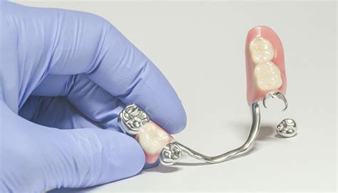 This article reviews the history of dental amalgam. What Are the Alternatives to Dental Amalgam? - Dimensions ...