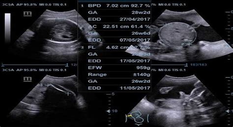Nah, demikian sedikit gambaran mengenai perkembangan janin di dalam rahim. Ibu Hamil Wajib Banget Tahu, Begini Cara Membaca Foto ...