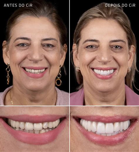 Implantes Dentários Hospital Odontológico Cir