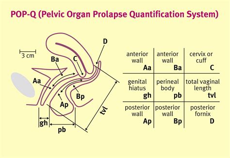 Pelvic Organ Prolapse Quantification System