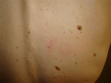 brown spots on back - pictures, photos