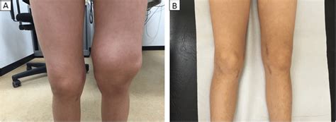 Clinical Photographs Showing Severe Swelling Of The Left Knee Joint At
