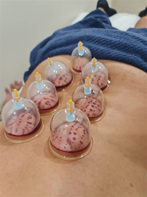 Hijama Wet Cupping Cup And Cleanse