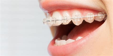 Ceramic Dental Braces Best Alternative To Straighten Teeth