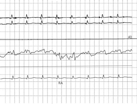 19 Cardiac Tamponade Thoracic Key