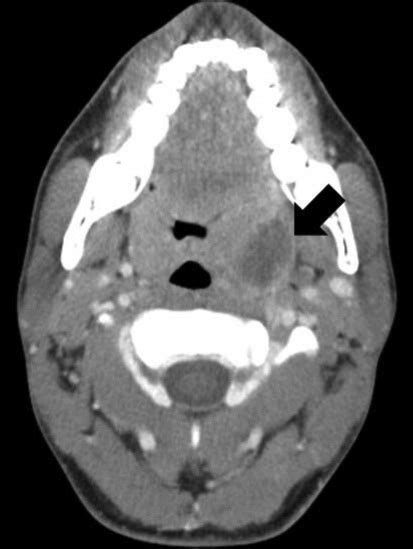 Computed Tomographic Findings Of Peritonsillar Abscess Precontrast