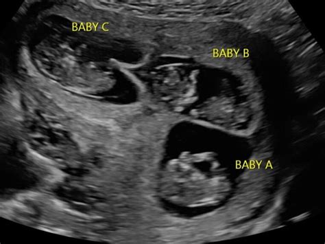 Triplet Ultrasound