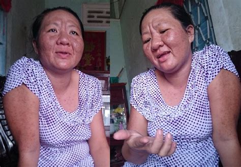 29歳の女性が60歳の老婆に、塗り薬の副作用で急激に老化 三面 Vietjoベトナムニュース