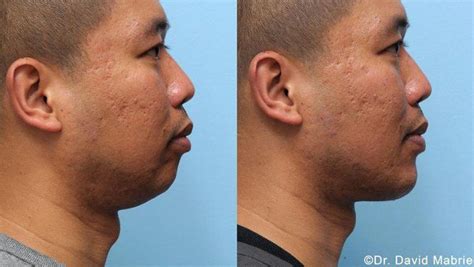 Nonsurgical Chin Augmentation Neck Slimming And Jaw Contouring In San