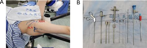 Frontiers Endoscopic Treatment For Calcific Tendinitis Of The Gluteus