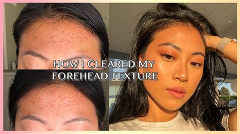 How To Really Get Rid Of Forehead Acne Texture Christine Le Youtube