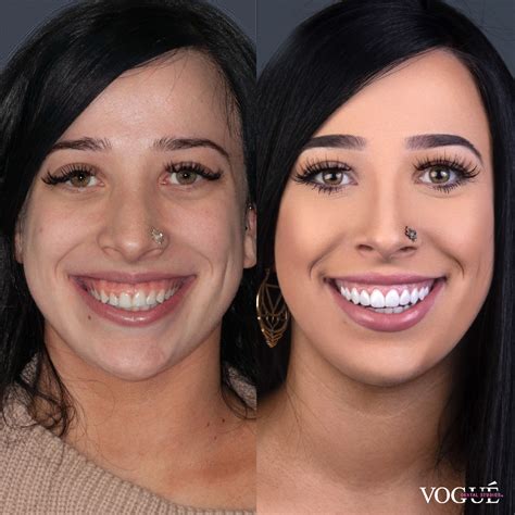 Gum Laser Surgery Vogue Dental Studios