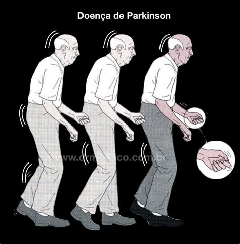 Treatment Of Parkinsons Disease
