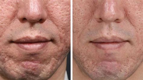 Microneedling For Acne Scars And Hair Loss Richmond Hill Cosmetic Clinic