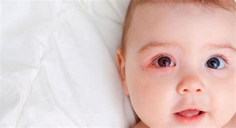 Problemas De Los Ojos En Bebés Y Niños Y Cómo Actuar