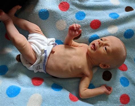 With cloth diapers, babies rarely get diaper rash. Premature Baby Cloth Diapers