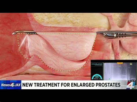 New Treatment For Enlarged Prostates Youtube