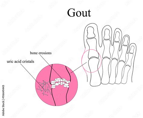 Diagram Of Gout In Human Toe Illustration Stock Vektorgrafik Adobe Stock