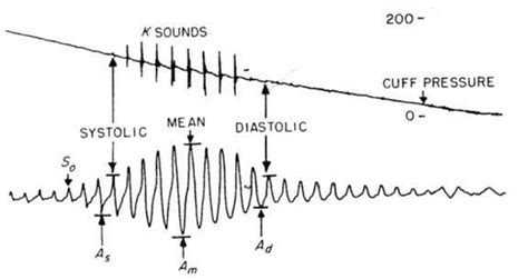 Upper Line Is Korotkoff Sound And Lower Line Is Oscillation Signal In