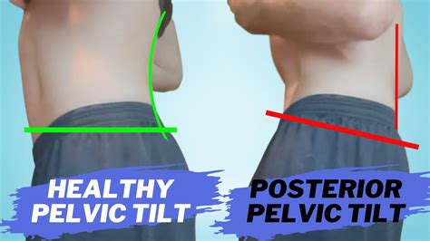 Posterior Pelvic Tilt Step Fix Youtube