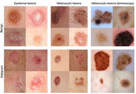 Stage Non Melanoma Skin Cancer Cancerwalls