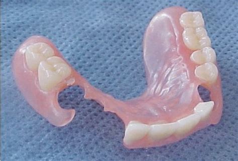 Removable Partial Denture For One Tooth Barneypigna