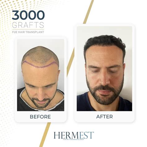 HAIR TRANSPLANT BEFORE AND AFTER PICTURES