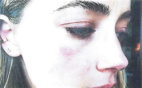 Amber Heard Shocking Photos Show Bruised Face After Johnny Depp Assault Claim London Evening