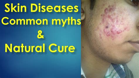 Skin Diseases Common Myths And Natural Cure Youtube