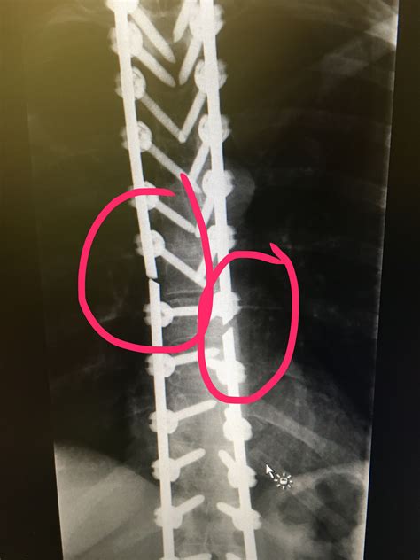 Broken spinal fusion rods | Spinal fusion, Spinal, Rods