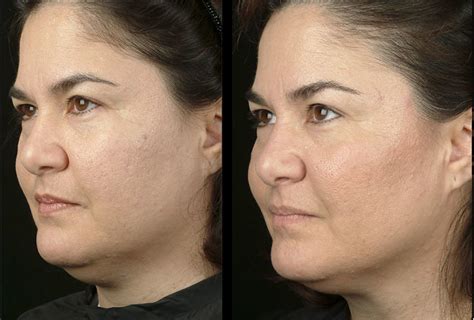 Before And After Face By Thermage™