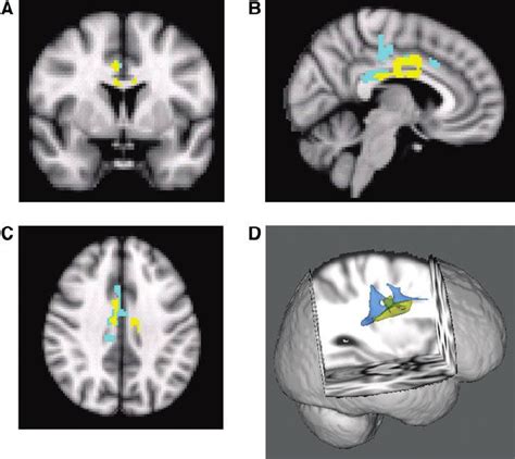 Amygdala Connectivity During The Neutral Scan Group Difference In