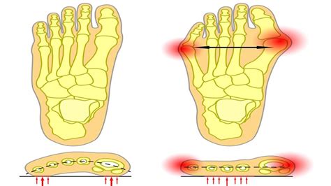 How To Get Rid Of Bunions On The Pinky Toe Pinky Toe Bunion